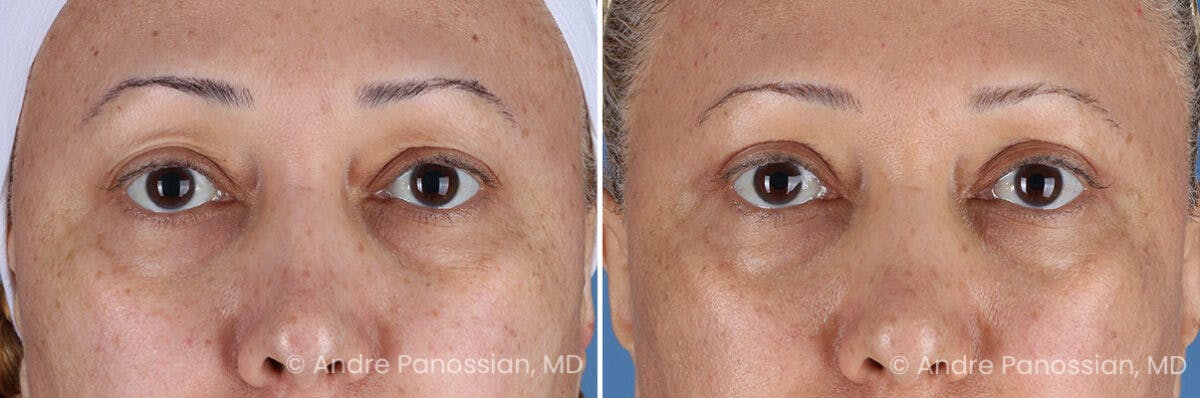 Eyelid Surgery (Blepharoplasty) Before & After Gallery - Patient 345439 - Image 1