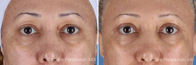 Eyelid Surgery (Blepharoplasty) Before & After Gallery - Patient 345439 - Image 1