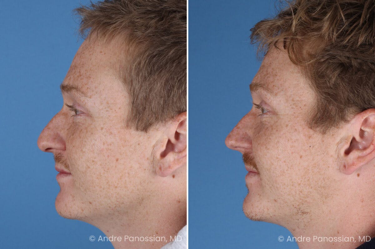 Rhinoplasty Before & After Gallery - Patient 433033 - Image 7