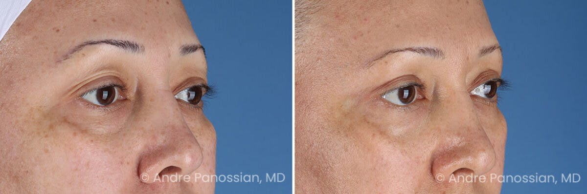 Eyelid Surgery (Blepharoplasty) Before & After Gallery - Patient 345439 - Image 2