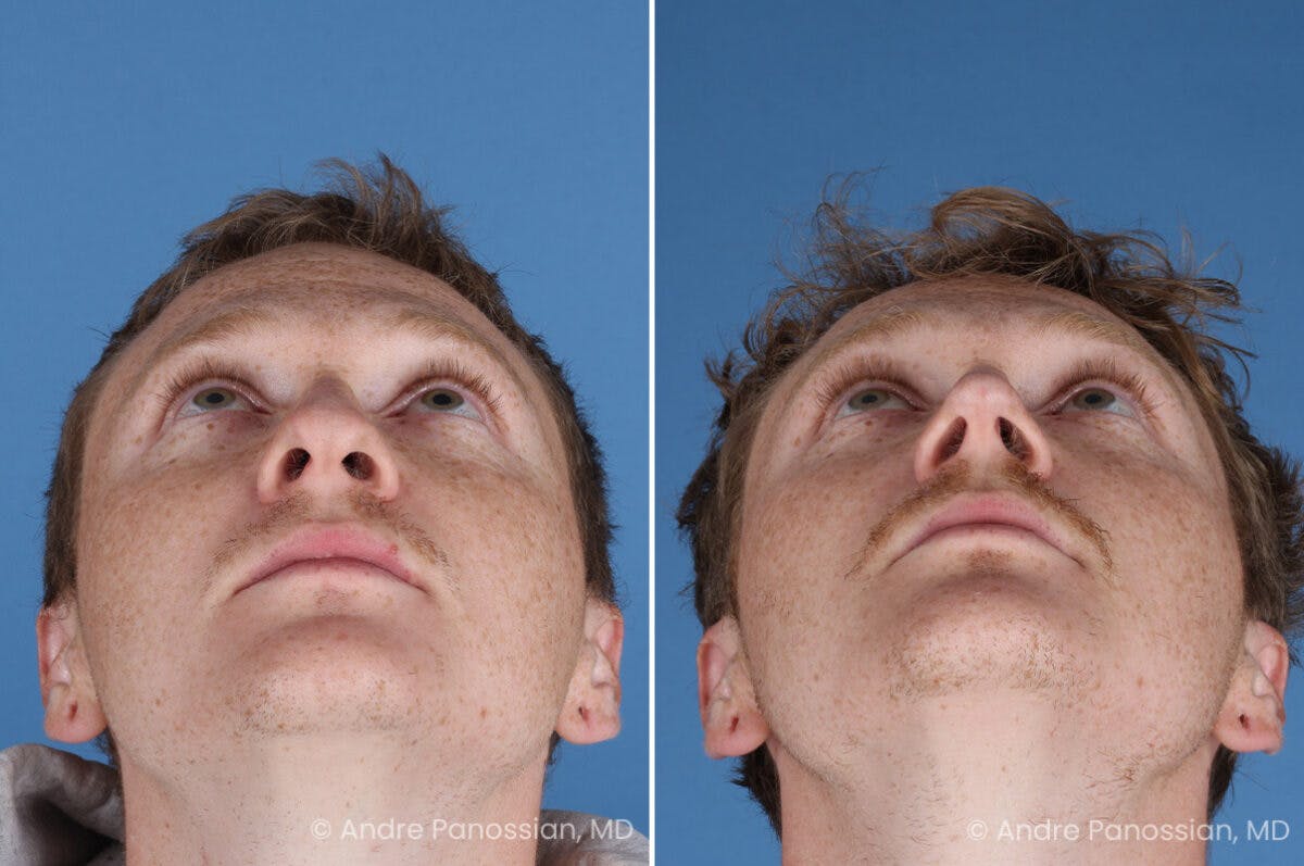 Rhinoplasty Before & After Gallery - Patient 433033 - Image 8