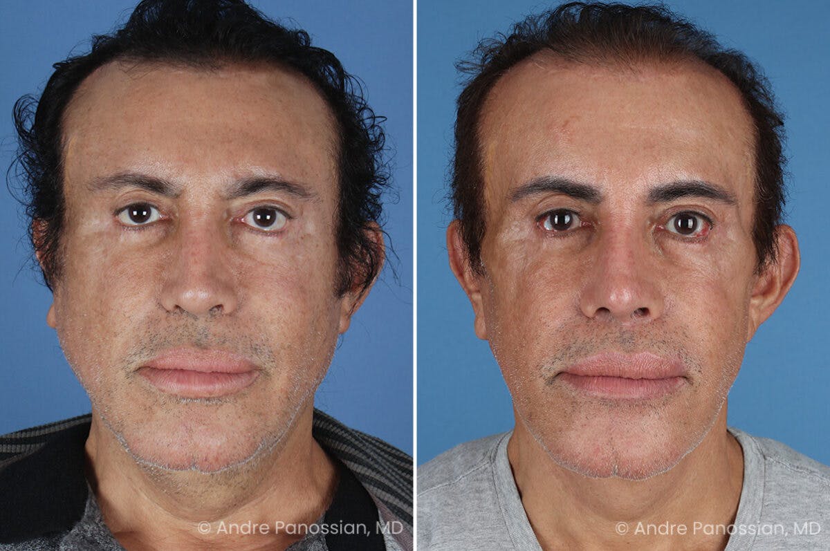 Revision Rhinoplasty Before & After Gallery - Patient 313534 - Image 2