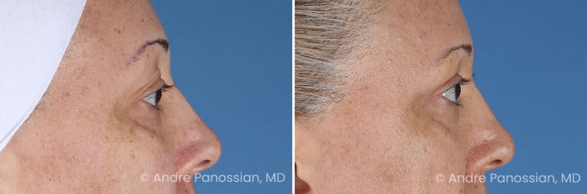 Eyelid Surgery (Blepharoplasty) Before & After Gallery - Patient 345439 - Image 3