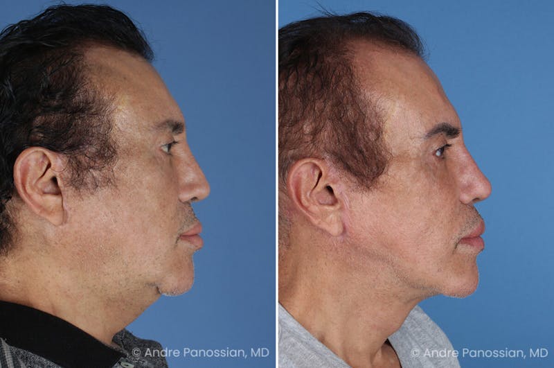 Revision Rhinoplasty Before & After Gallery - Patient 313534 - Image 1