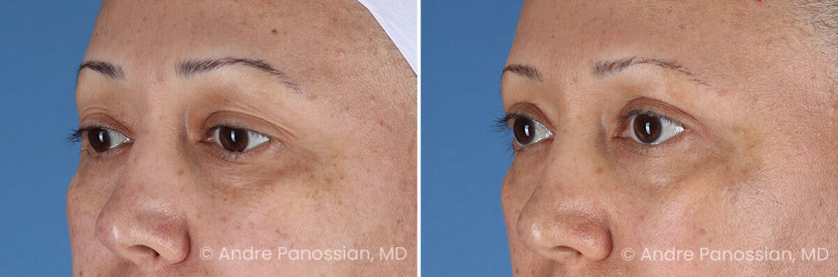 Eyelid Surgery (Blepharoplasty) Before & After Gallery - Patient 345439 - Image 4