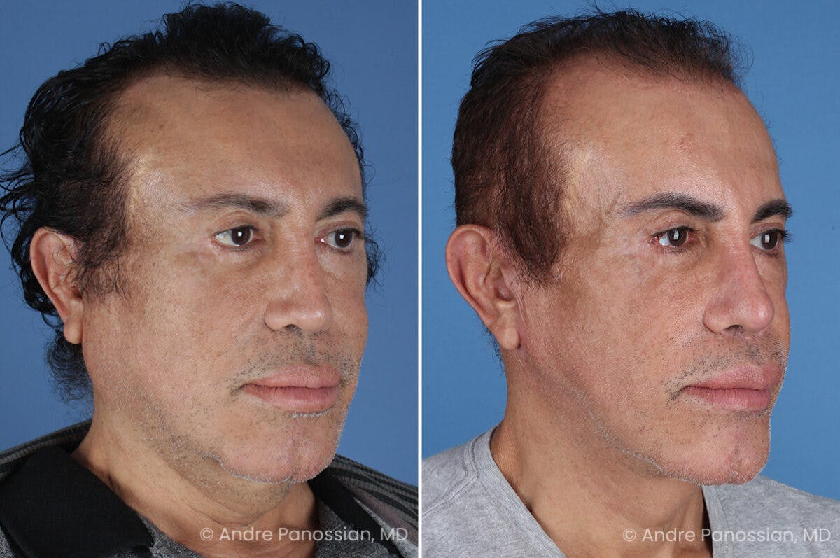 Revision Rhinoplasty Before & After Gallery - Patient 313534 - Image 3