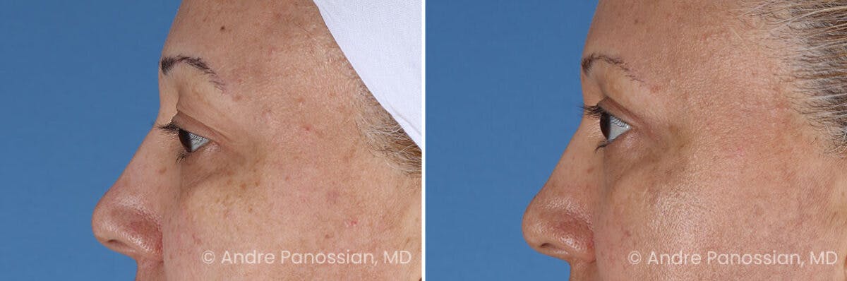 Eyelid Surgery (Blepharoplasty) Before & After Gallery - Patient 345439 - Image 5