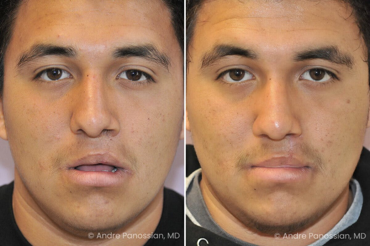 Cleft Lip Rhinoplasty Before & After Gallery - Patient 169299 - Image 2