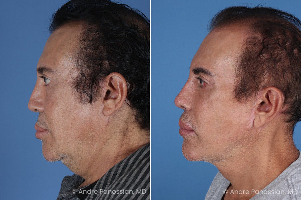 Revision Rhinoplasty Before & After Gallery - Patient 313534 - Image 4