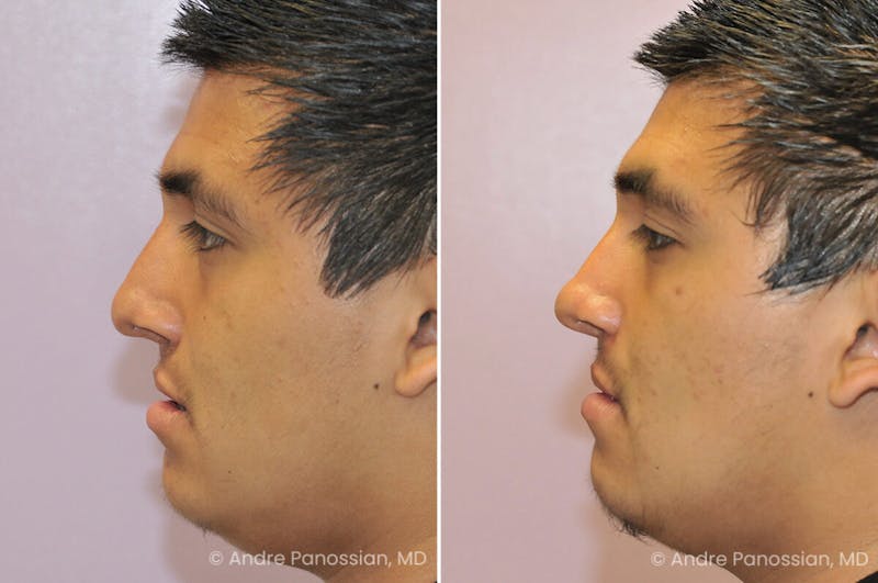 Cleft Lip Rhinoplasty Before & After Gallery - Patient 169299 - Image 1