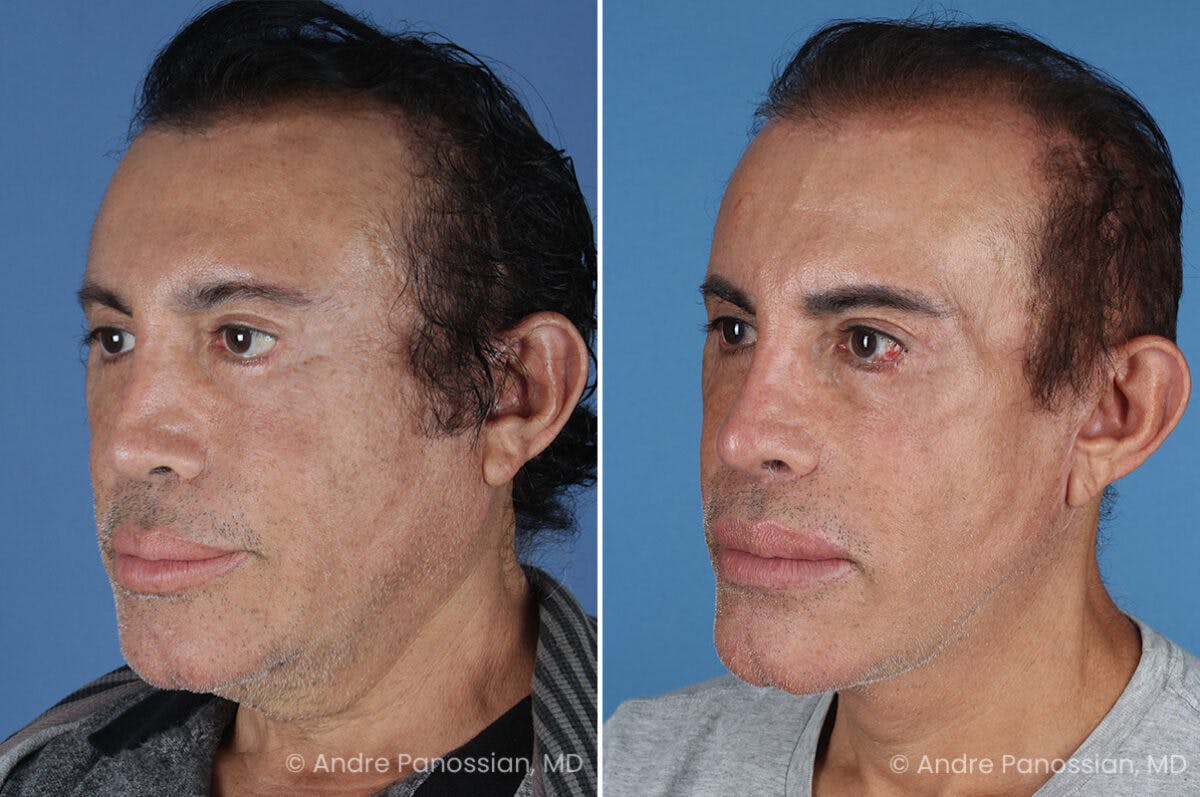 Revision Rhinoplasty Before & After Gallery - Patient 313534 - Image 5