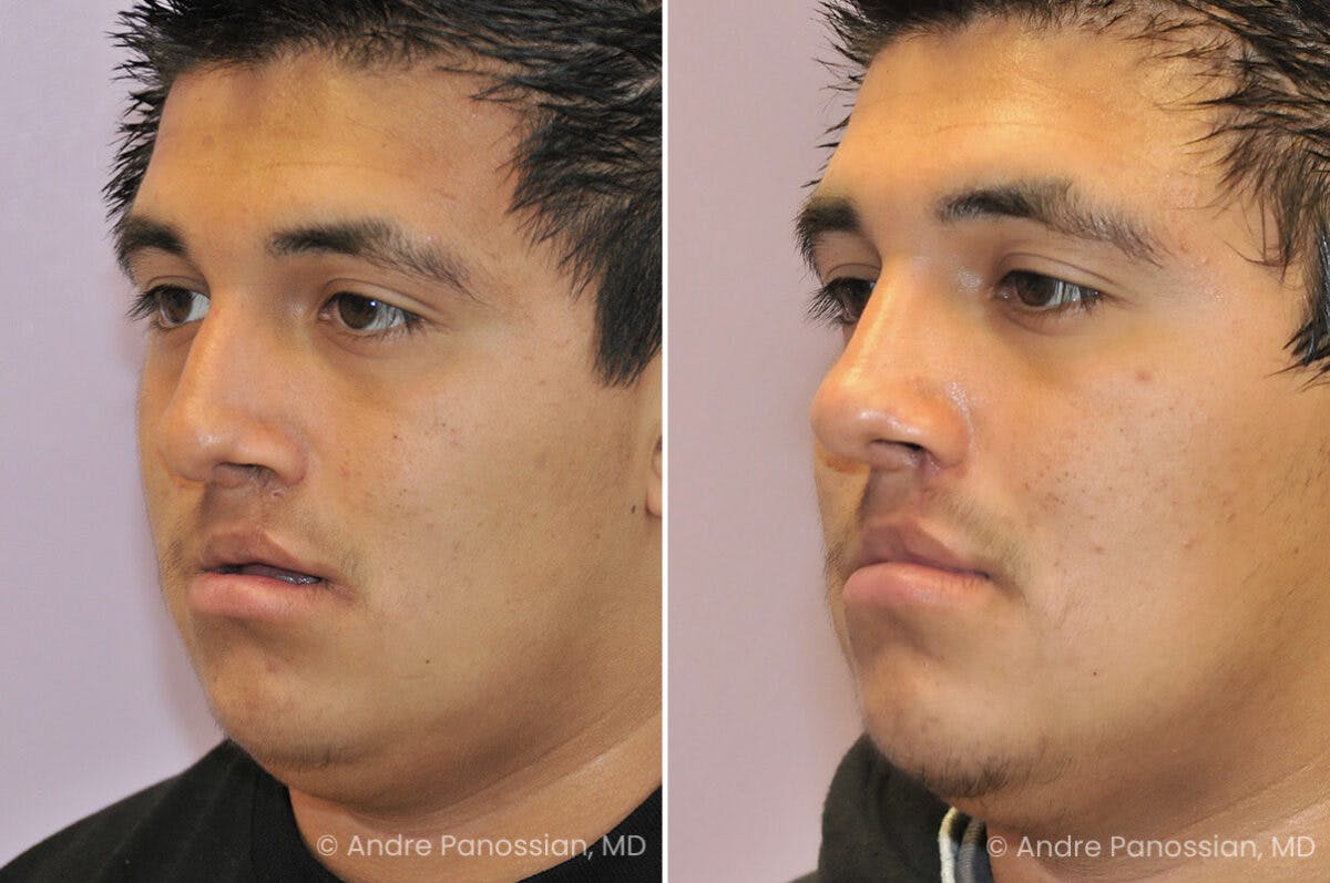 Cleft Lip Rhinoplasty Before & After Gallery - Patient 169299 - Image 3