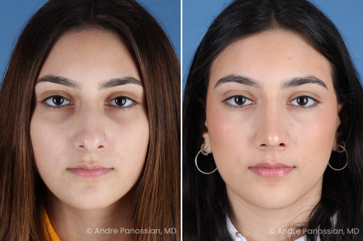 Rhinoplasty Before & After Gallery - Patient 175387 - Image 2
