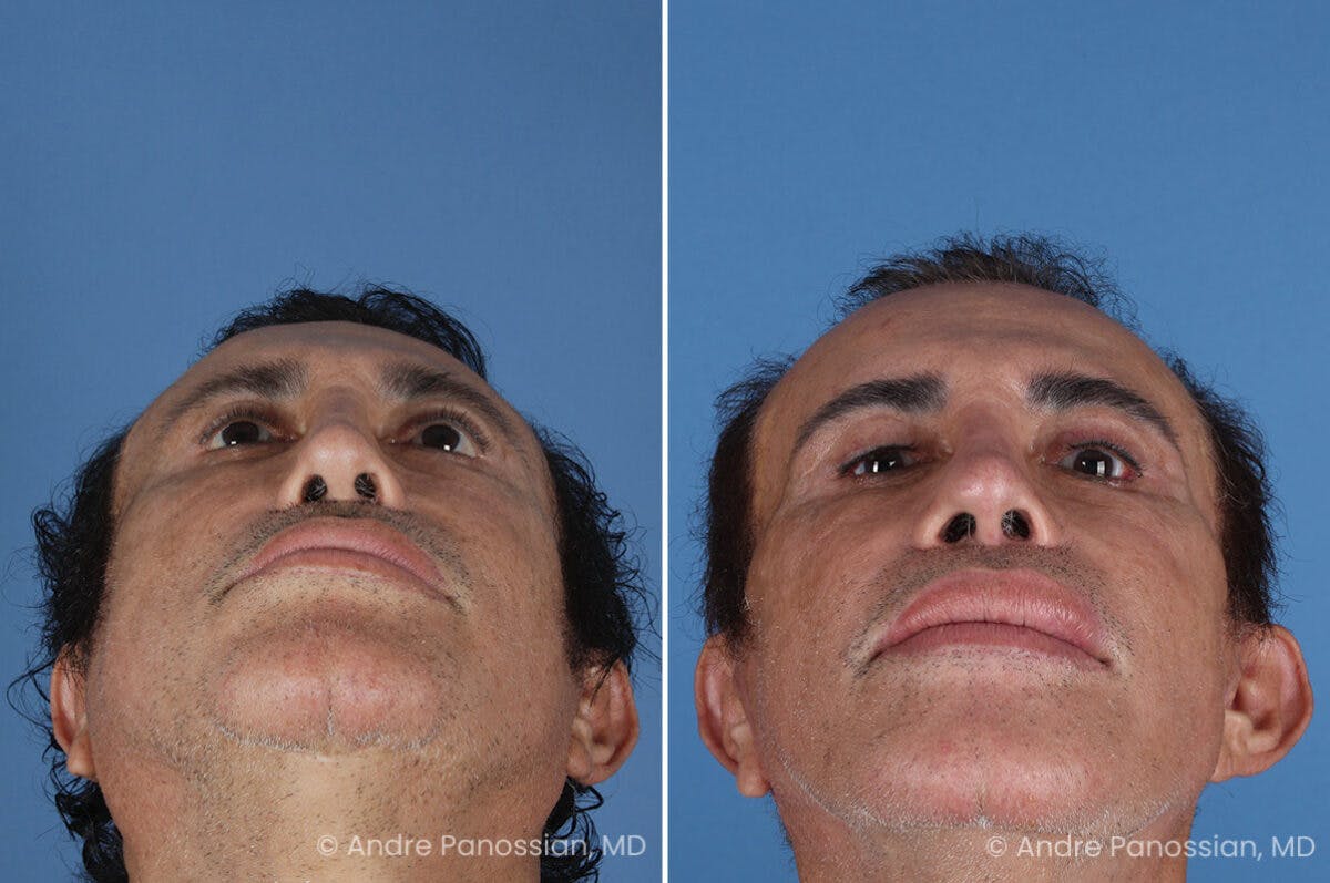 Revision Rhinoplasty Before & After Gallery - Patient 313534 - Image 6