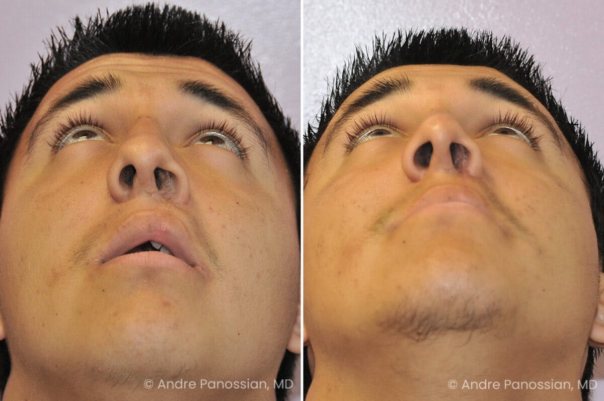 Cleft Lip Rhinoplasty Before & After Gallery - Patient 169299 - Image 4