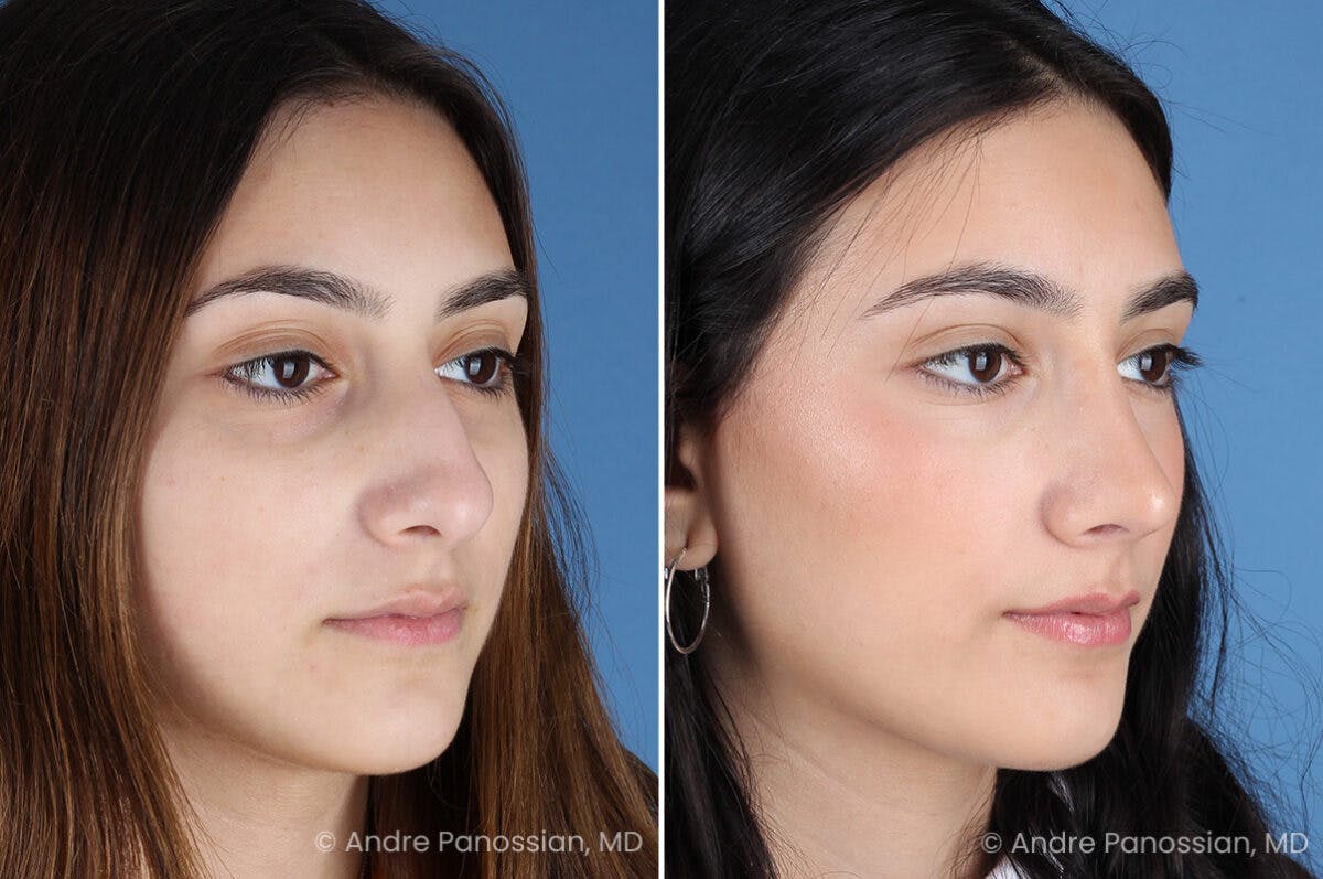 Rhinoplasty Before & After Gallery - Patient 175387 - Image 3