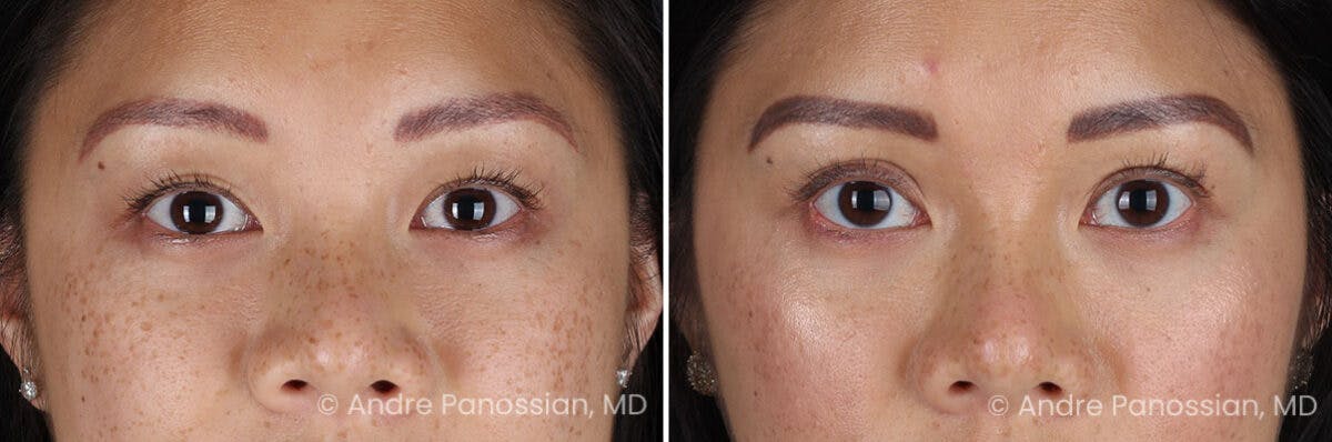 Eyelid Surgery (Blepharoplasty) Before & After Gallery - Patient 349555 - Image 1