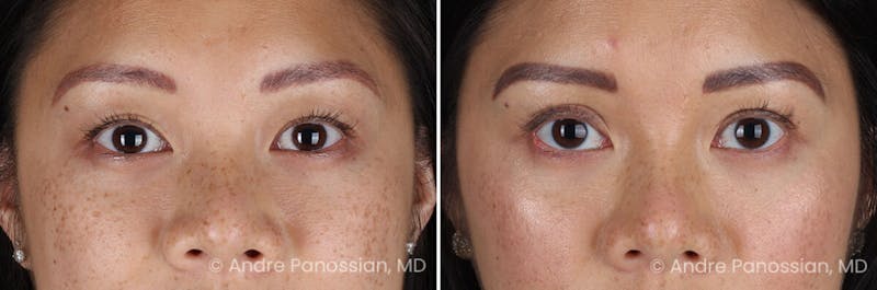 Eyelid Surgery (Blepharoplasty) Before & After Gallery - Patient 349555 - Image 1