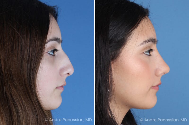 Rhinoplasty Before & After Gallery - Patient 175387 - Image 1