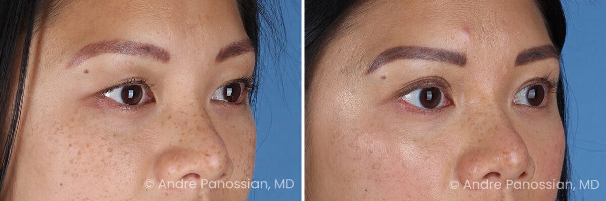 Eyelid Surgery (Blepharoplasty) Before & After Gallery - Patient 349555 - Image 2