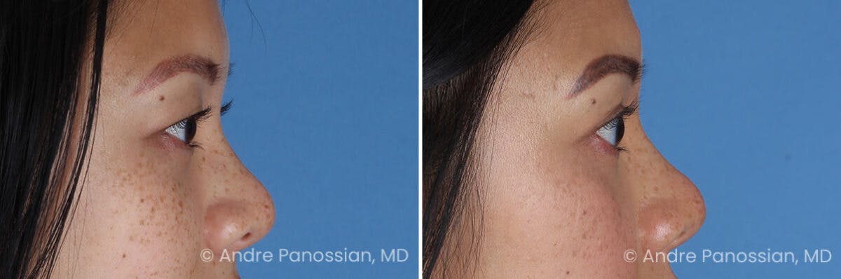 Eyelid Surgery (Blepharoplasty) Before & After Gallery - Patient 349555 - Image 3