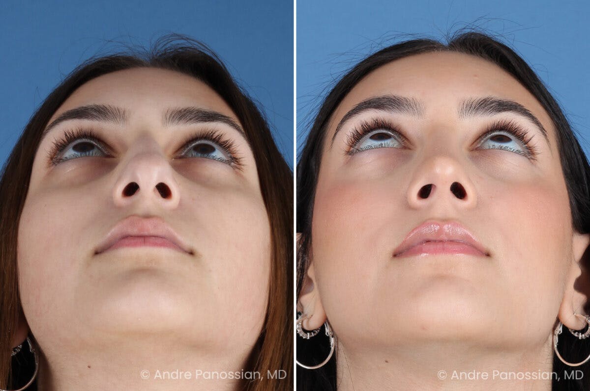 Rhinoplasty Before & After Gallery - Patient 175387 - Image 4