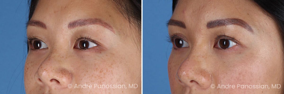 Eyelid Surgery (Blepharoplasty) Before & After Gallery - Patient 349555 - Image 4