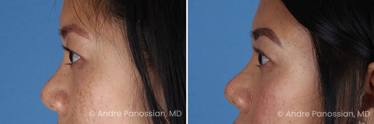 Eyelid Surgery (Blepharoplasty) Before & After Gallery - Patient 349555 - Image 5