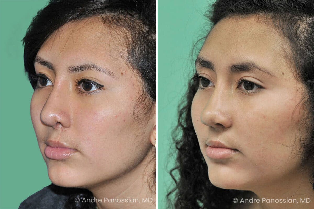 Cleft Lip Rhinoplasty Before & After Gallery - Patient 309053 - Image 3
