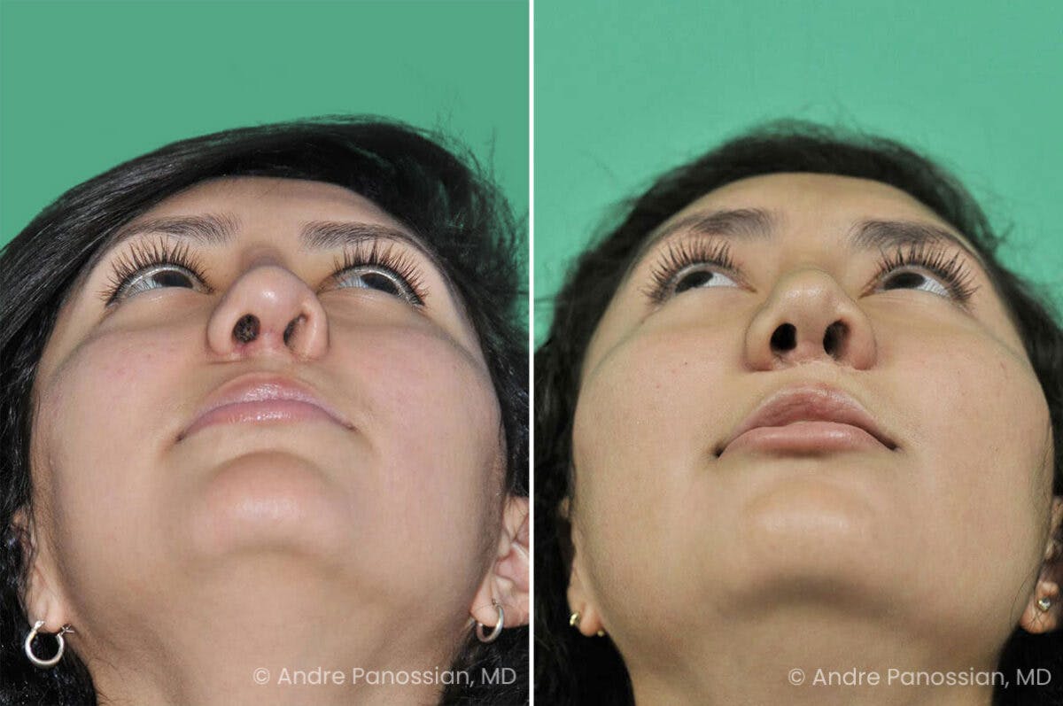 Cleft Lip Rhinoplasty Before & After Gallery - Patient 309053 - Image 4