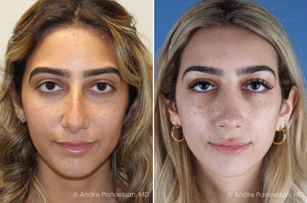 Rhinoplasty Before & After Gallery - Patient 254384 - Image 2
