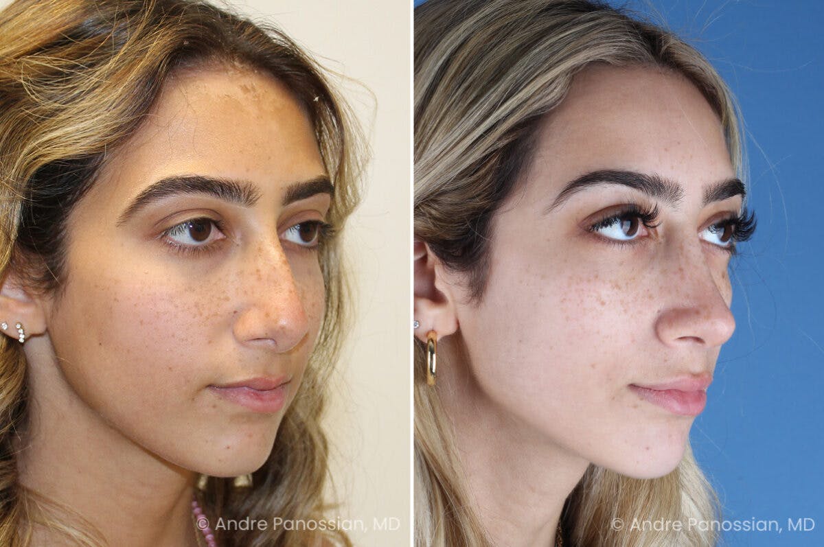 Rhinoplasty Before & After Gallery - Patient 254384 - Image 3