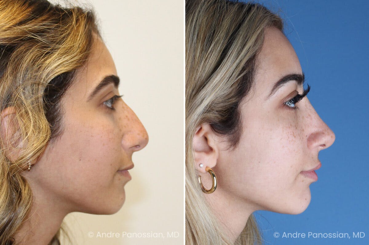 Rhinoplasty Before & After Gallery - Patient 254384 - Image 1