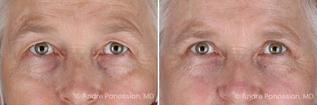 Eyelid Surgery (Blepharoplasty) Before & After Gallery - Patient 428370 - Image 1