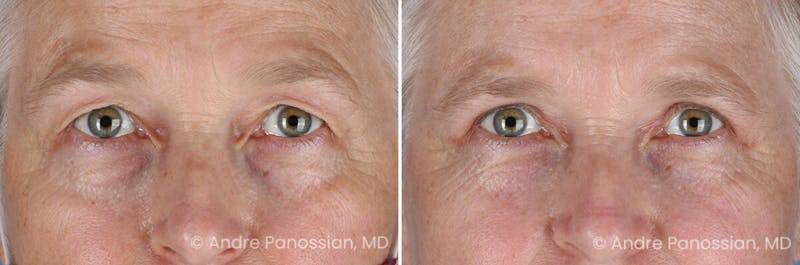 Eyelid Surgery (Blepharoplasty) Before & After Gallery - Patient 428370 - Image 1