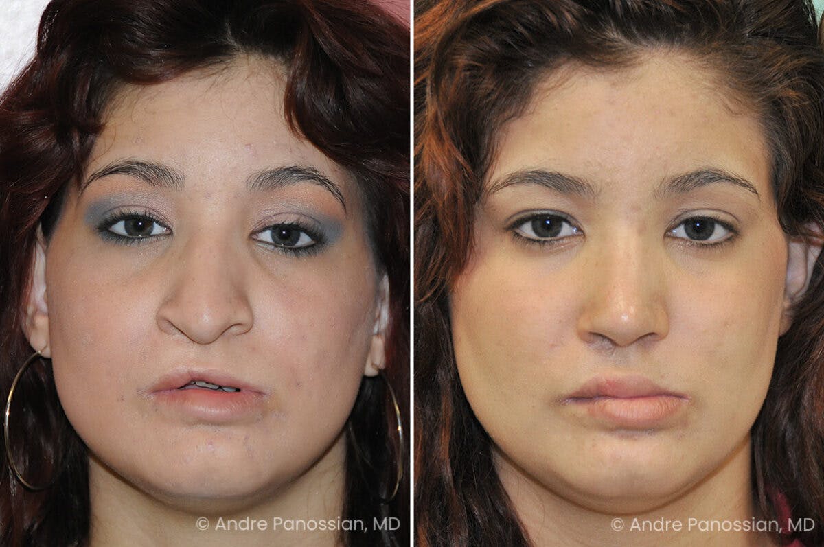 Cleft Lip Rhinoplasty Before & After Gallery - Patient 273575 - Image 2