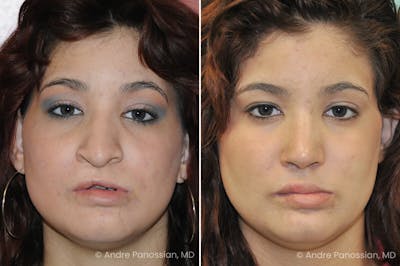 Cleft Lip Rhinoplasty Before & After Photos | Page 2 | Andre Panossian ...