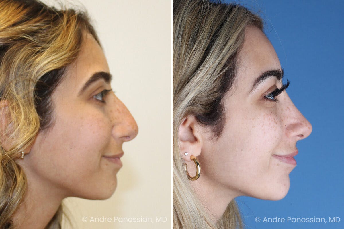 Rhinoplasty Before & After Gallery - Patient 254384 - Image 4