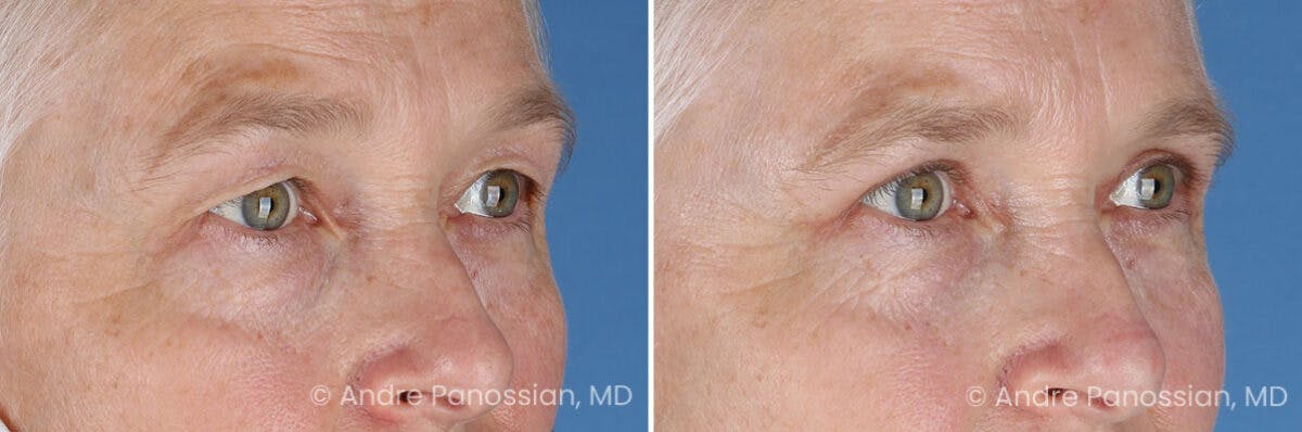 Eyelid Surgery (Blepharoplasty) Before & After Gallery - Patient 428370 - Image 2
