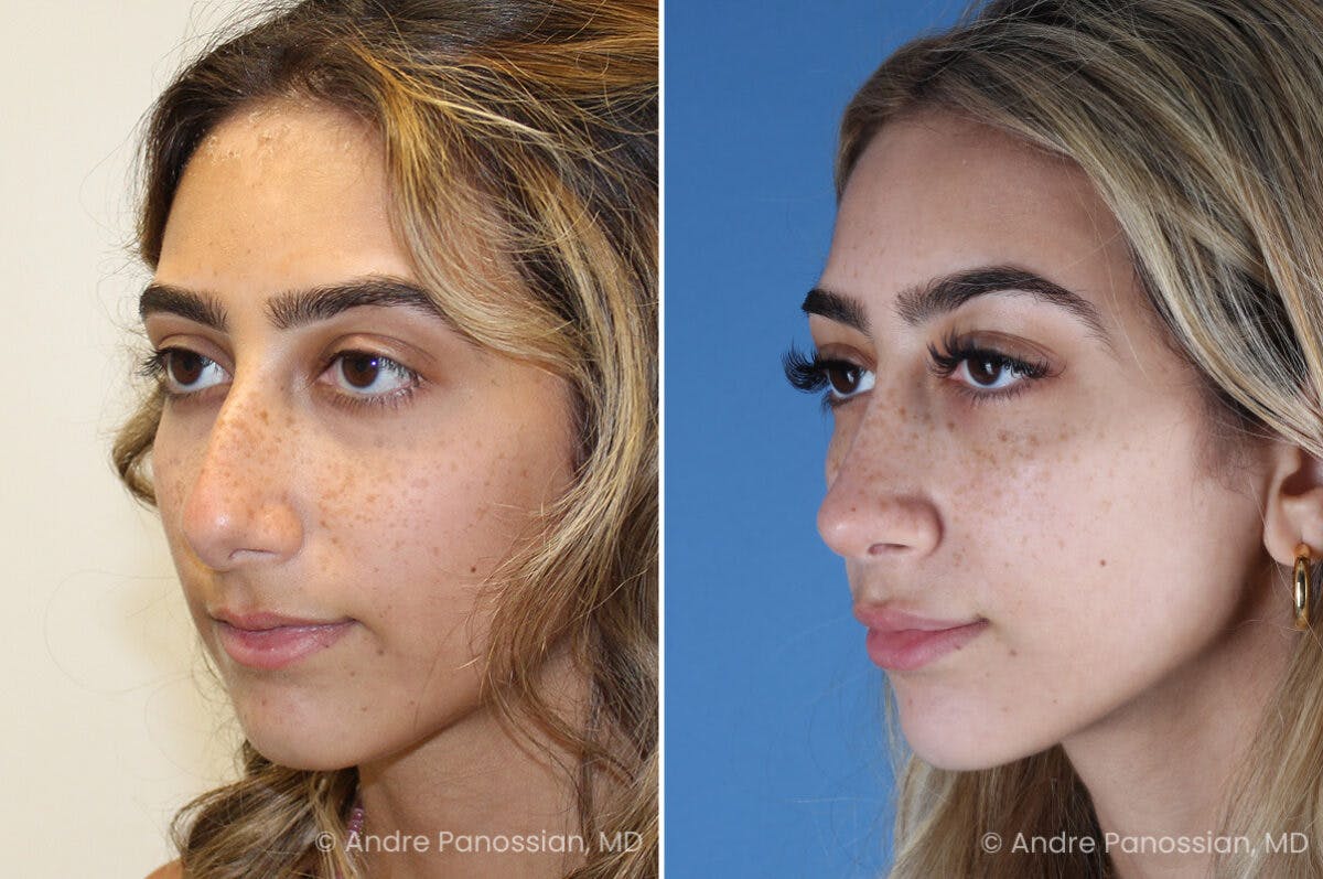 Rhinoplasty Before & After Gallery - Patient 254384 - Image 5