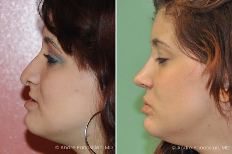Cleft Lip Rhinoplasty Before & After Gallery - Patient 273575 - Image 1