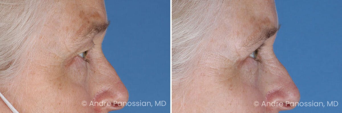Eyelid Surgery (Blepharoplasty) Before & After Gallery - Patient 428370 - Image 3