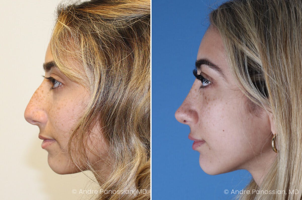Rhinoplasty Before & After Gallery - Patient 254384 - Image 6