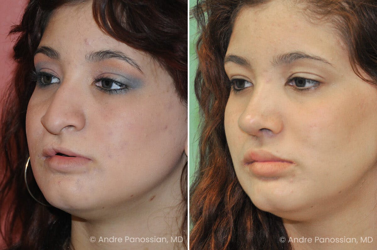 Cleft Lip Rhinoplasty Before & After Gallery - Patient 273575 - Image 3