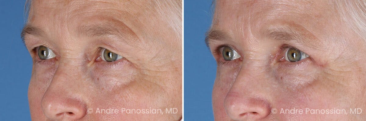 Eyelid Surgery (Blepharoplasty) Before & After Gallery - Patient 428370 - Image 4