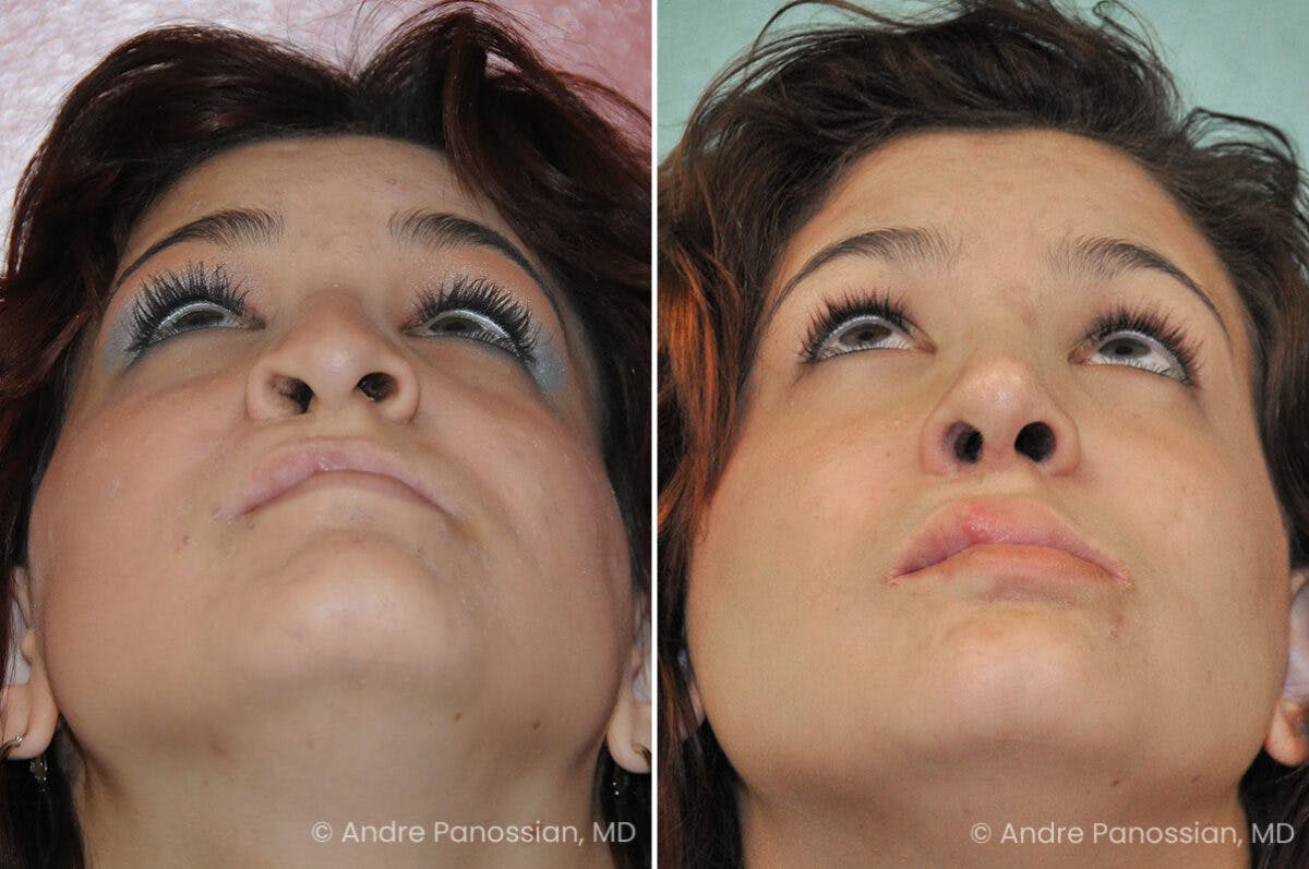 Cleft Lip Rhinoplasty Before & After Gallery - Patient 273575 - Image 4