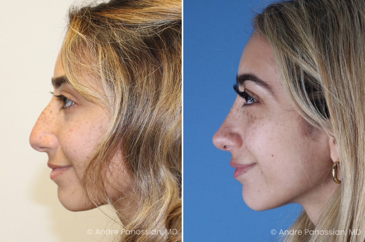 Rhinoplasty Before & After Gallery - Patient 254384 - Image 7