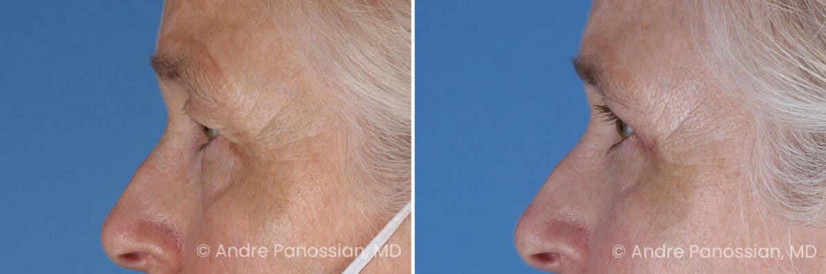 Eyelid Surgery (Blepharoplasty) Before & After Gallery - Patient 428370 - Image 5