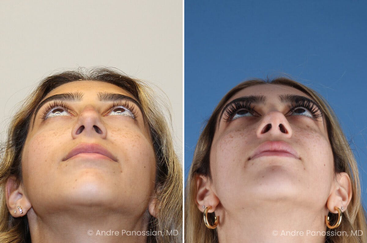 Rhinoplasty Before & After Gallery - Patient 254384 - Image 8