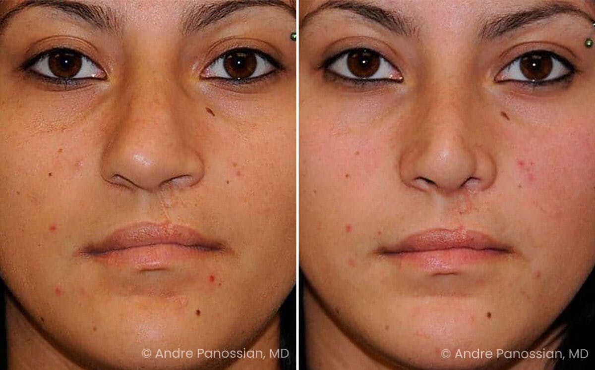Cleft Lip Rhinoplasty Before & After Gallery - Patient 141370 - Image 2